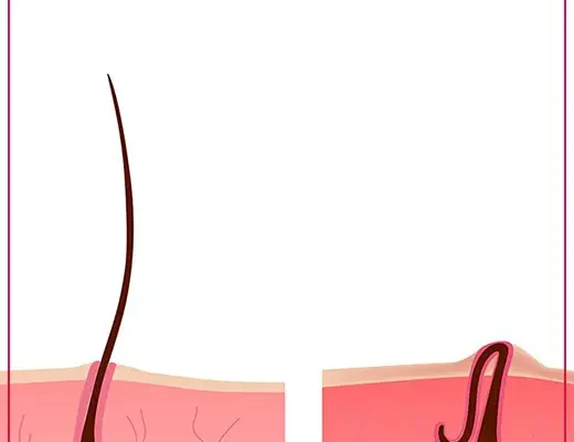 How to Get Rid of Ingrown Hair on Legs: A Comprehensive Guide