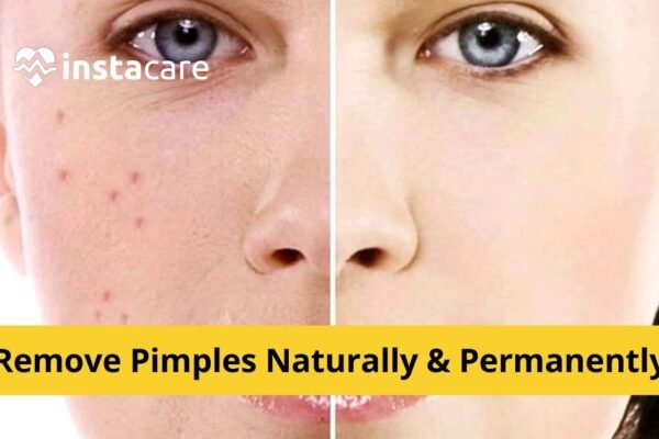 How to Get Rid of Pimples on Face: Natural Remedies and Expert Tips